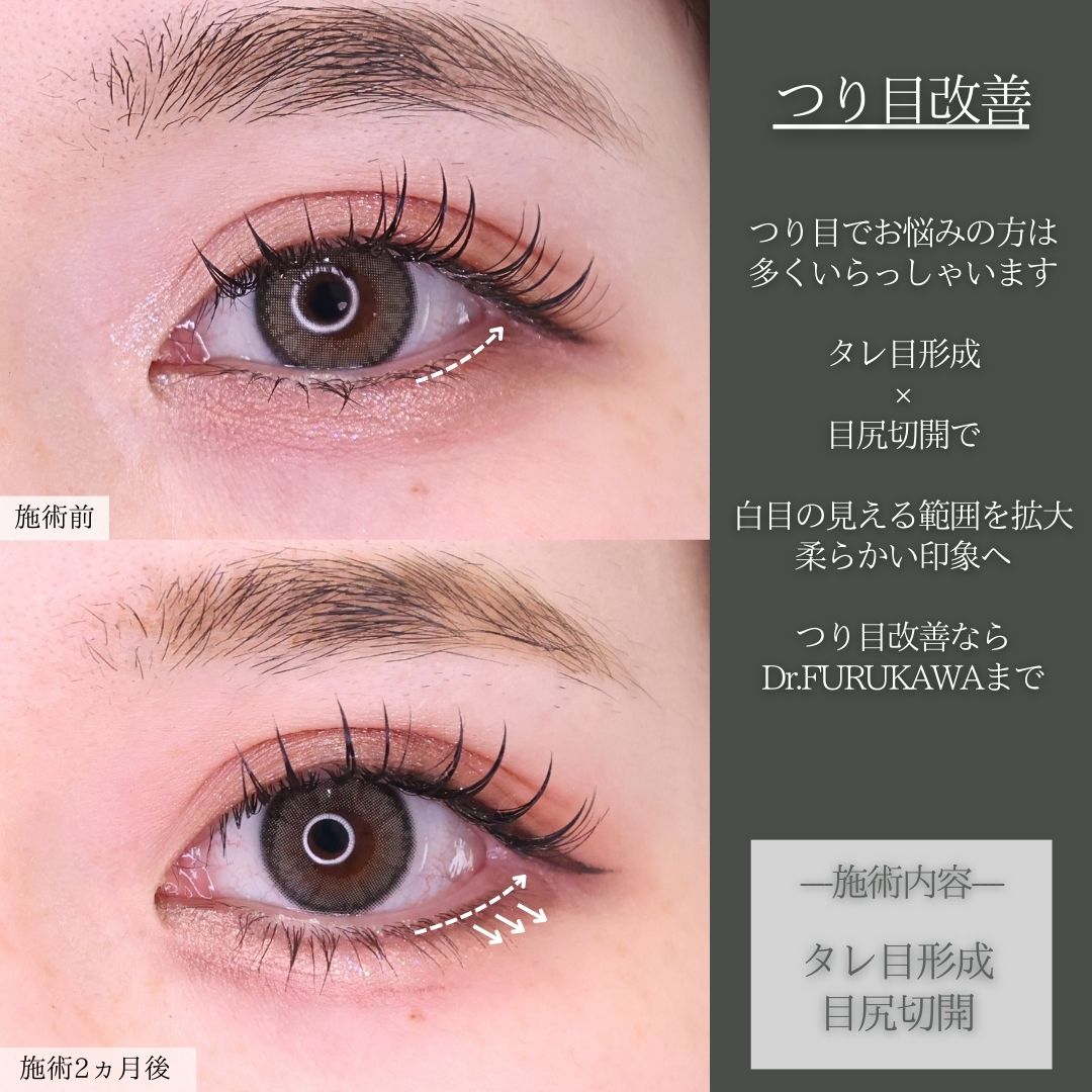 グラマラスライン（タレ目形成）/目尻切開術の症例写真 施術前後 