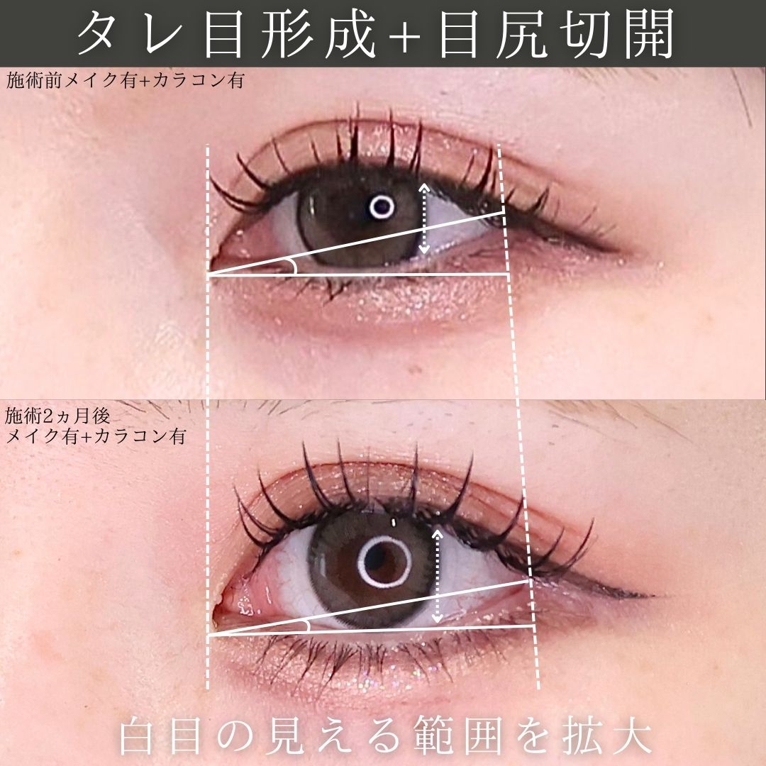 グラマラスライン（タレ目形成）/目尻切開術の症例写真 施術前後 