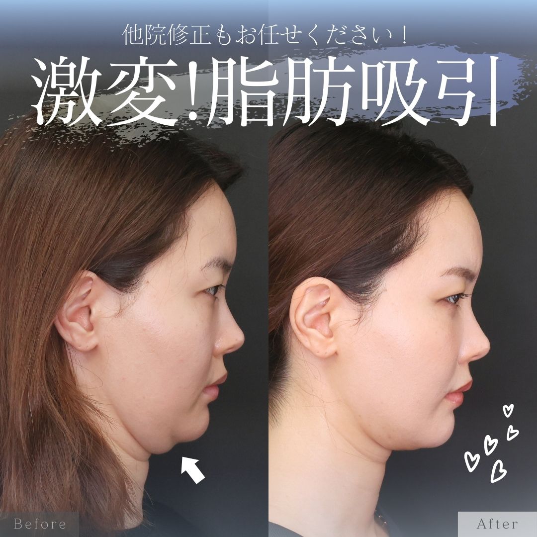 TAC式 ツヤ肌コラーゲンリフト®/ジョールファット除去/Lラインファット除去（エラ下脂肪除去）の症例写真 施術前後 