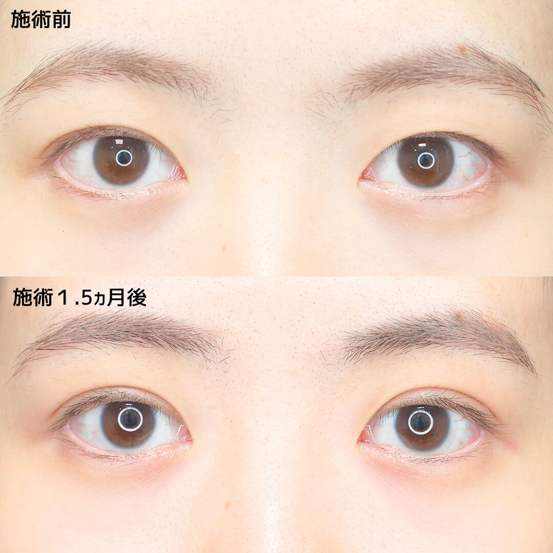 二重埋没法の症例写真 施術前後 