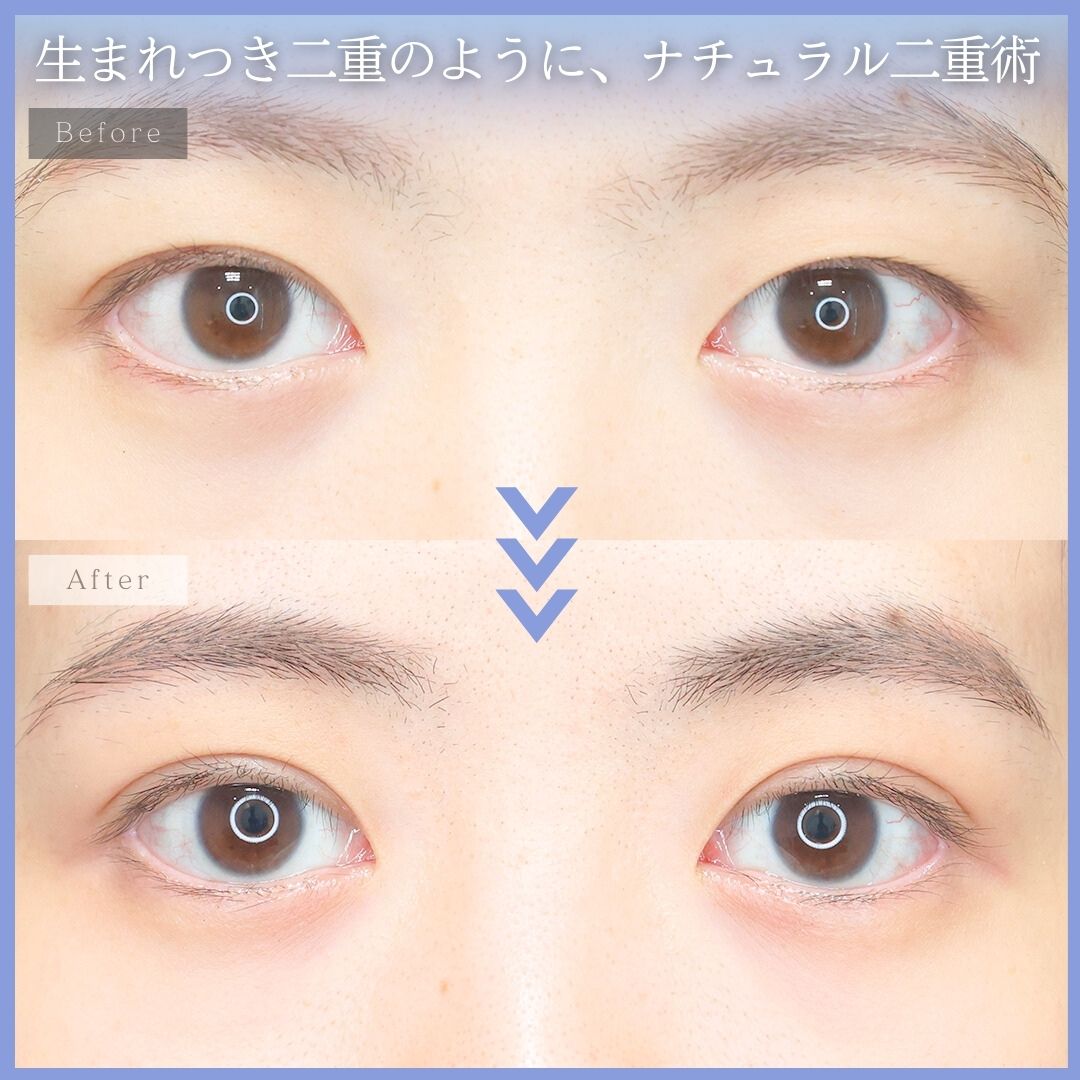 二重埋没法の症例写真 施術前後 