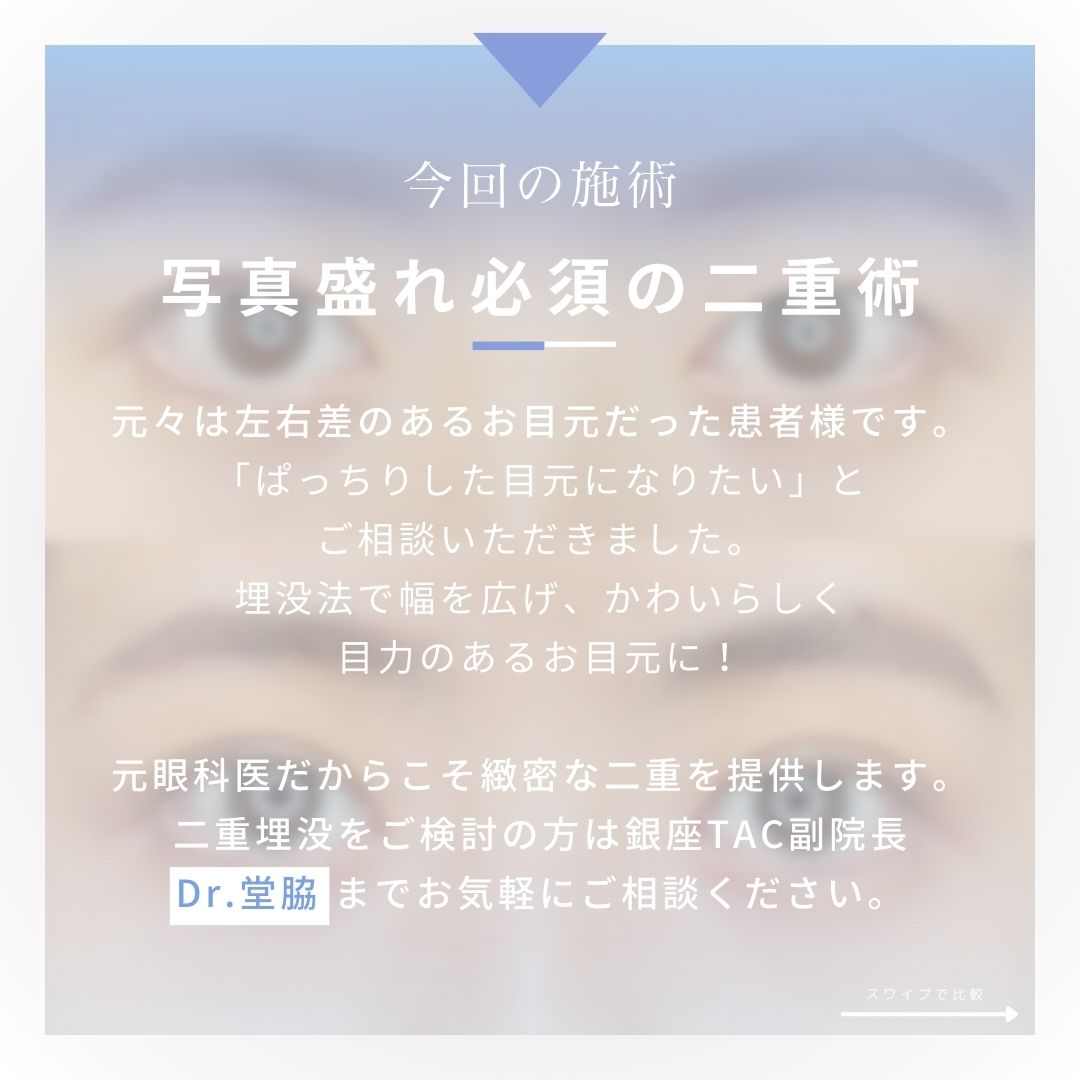 二重埋没法の症例写真 施術前後 