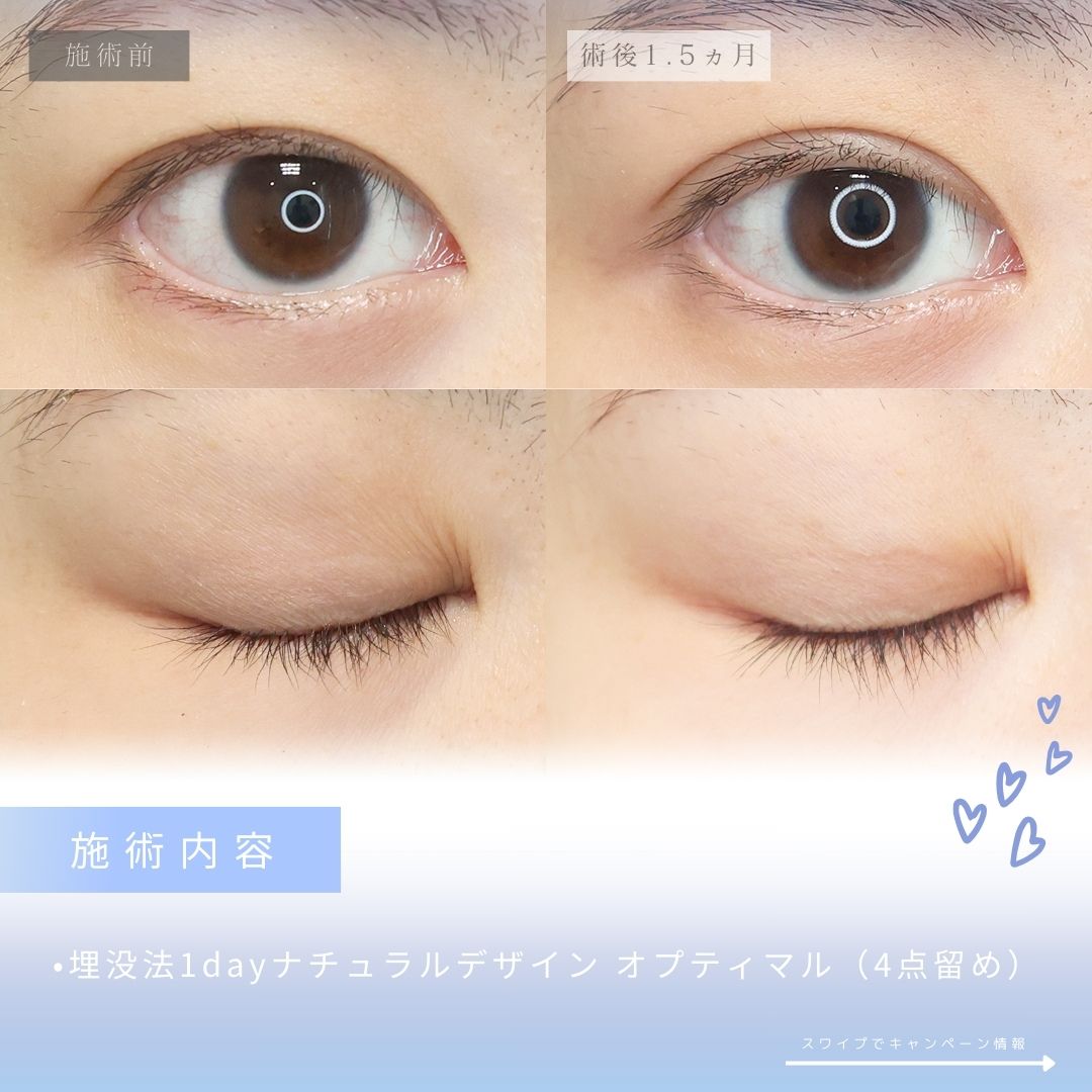 二重埋没法の症例写真 施術前後 