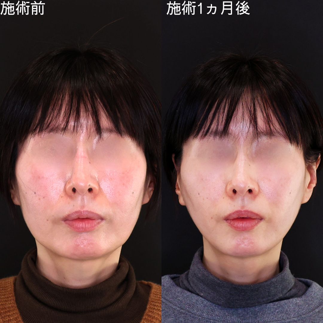 TAC式 ツヤ肌コラーゲンリフト®/TAC式 ショッピングリフトの症例写真 施術前後