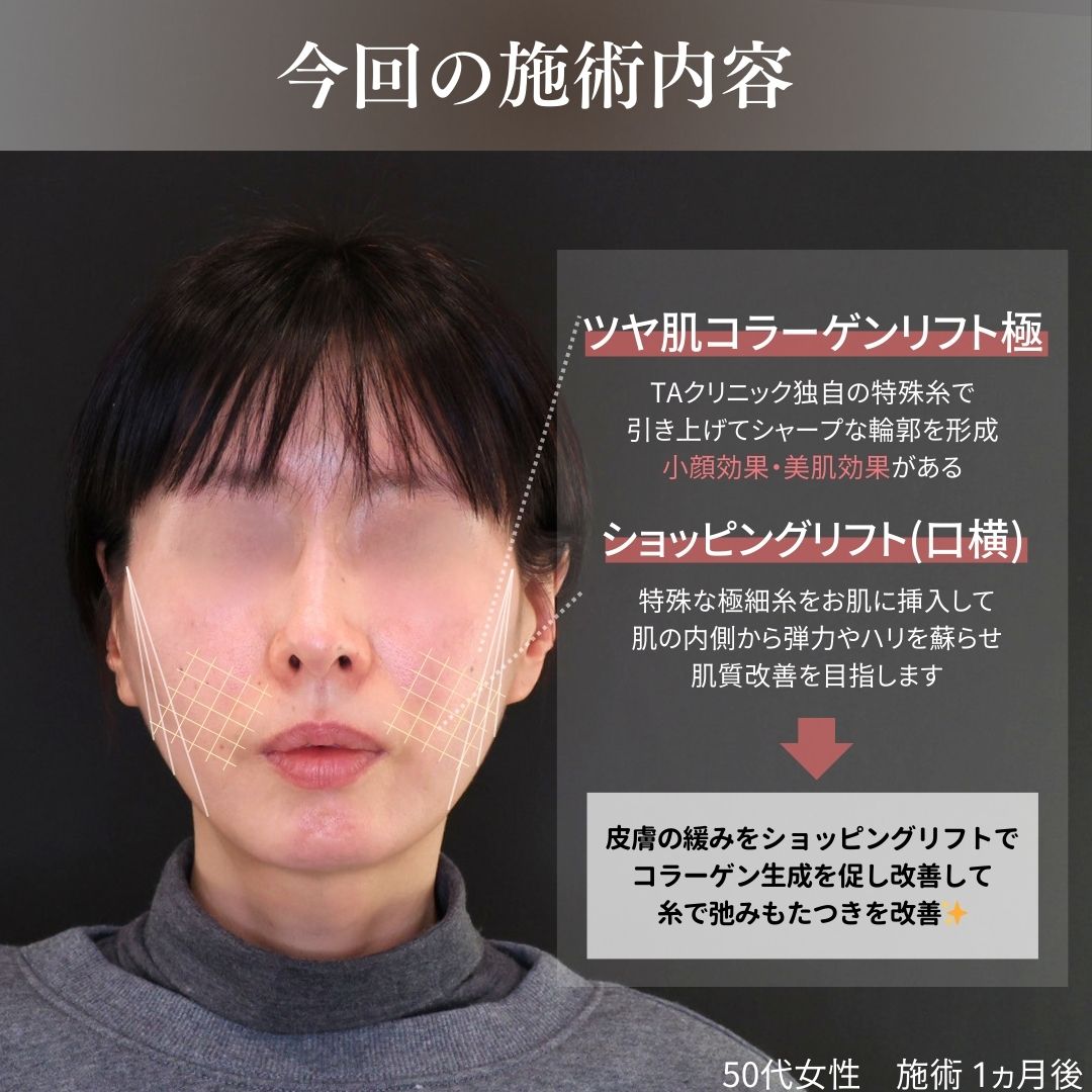 TAC式 ツヤ肌コラーゲンリフト®/TAC式 ショッピングリフトの症例写真 施術前後