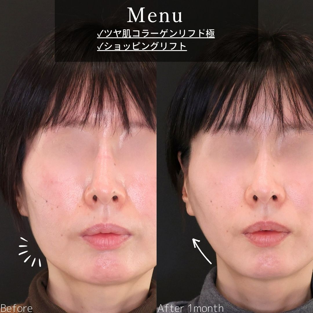 TAC式 ツヤ肌コラーゲンリフト®/TAC式 ショッピングリフトの症例写真 施術前後