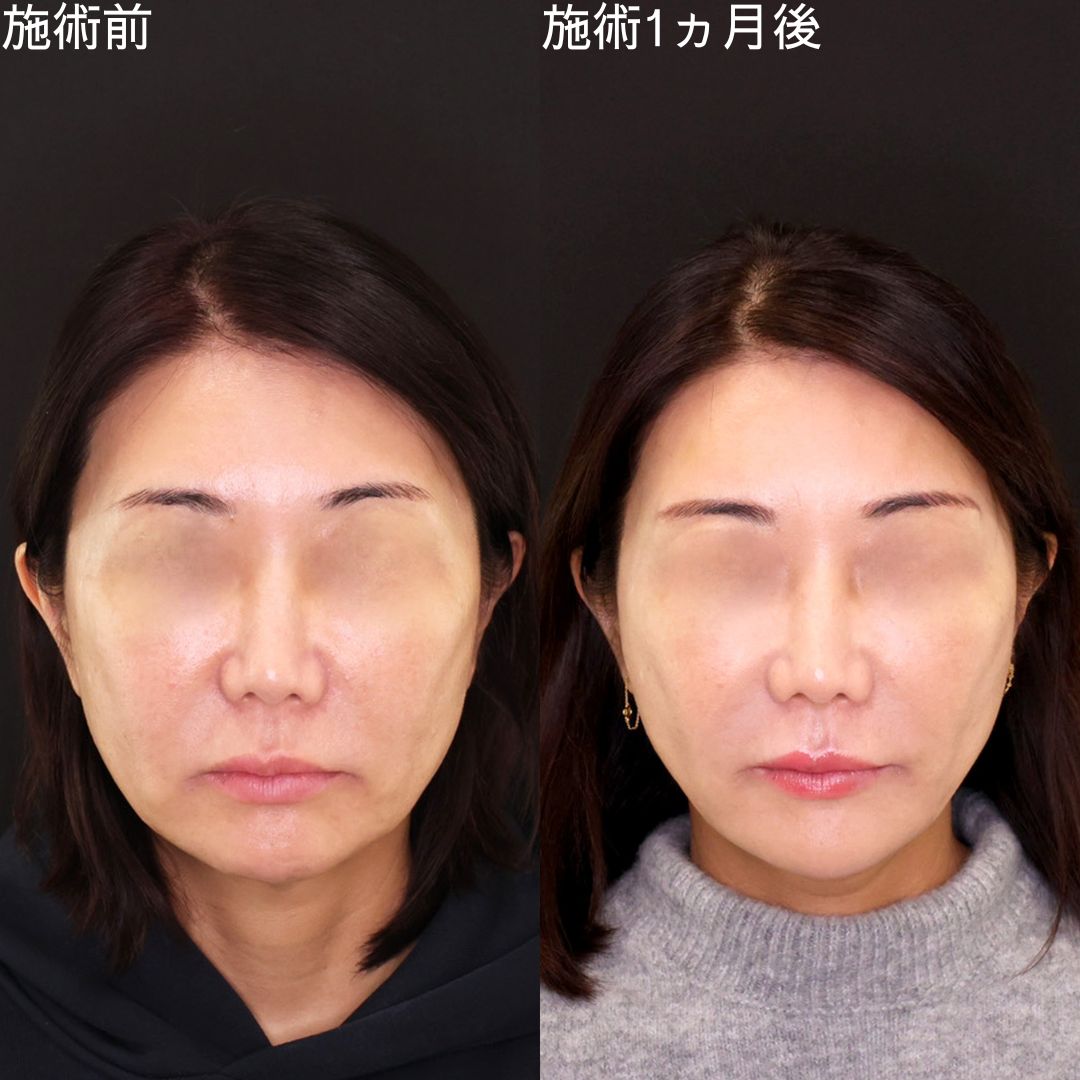 輪郭のボコつきを美しく改善！若返り小顔術【糸リフト】