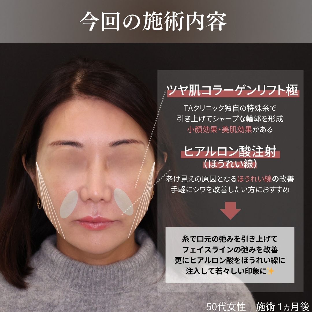 TAC式 ツヤ肌コラーゲンリフト®/ほうれい線のヒアルロン酸注射の症例写真 施術前後 