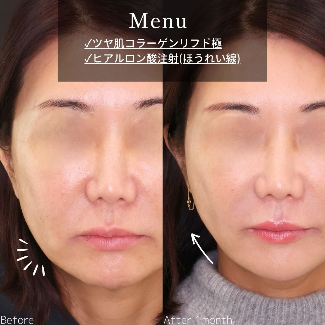 TAC式 ツヤ肌コラーゲンリフト®/ほうれい線のヒアルロン酸注射の症例写真 施術前後 