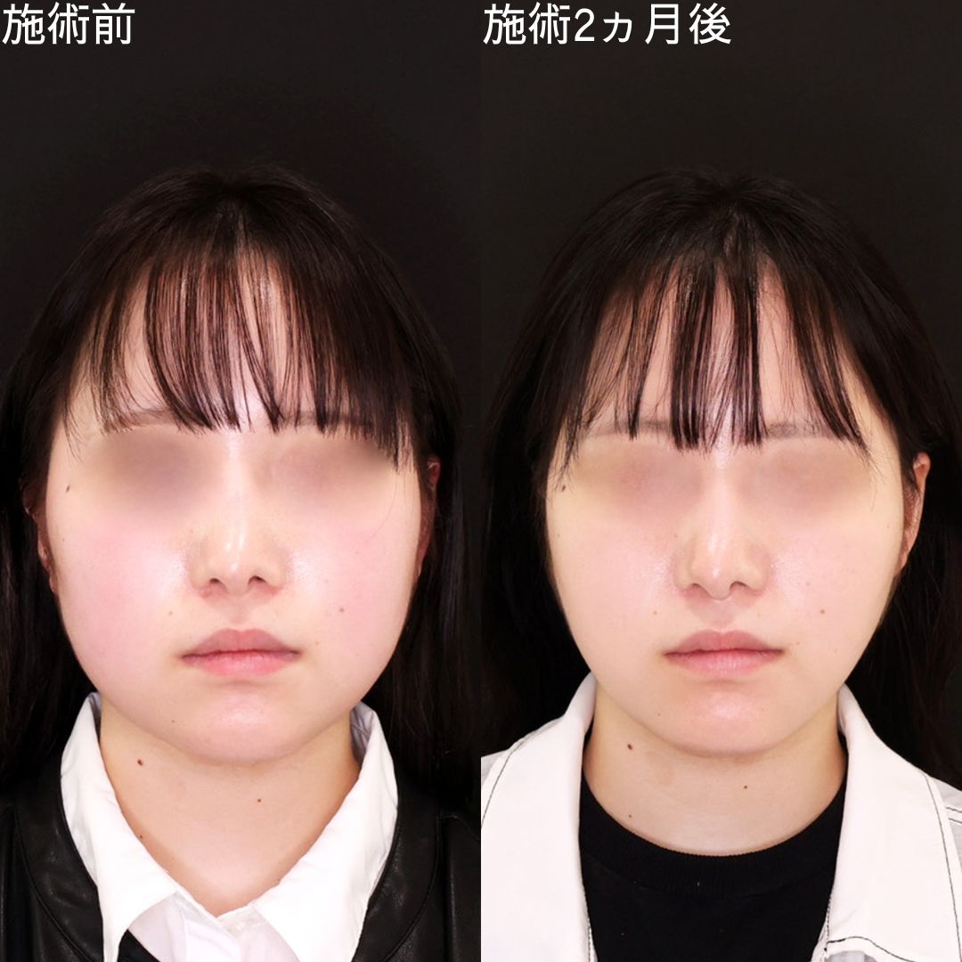 お顔の余白を減らして確実に垢抜ける【糸リフト】