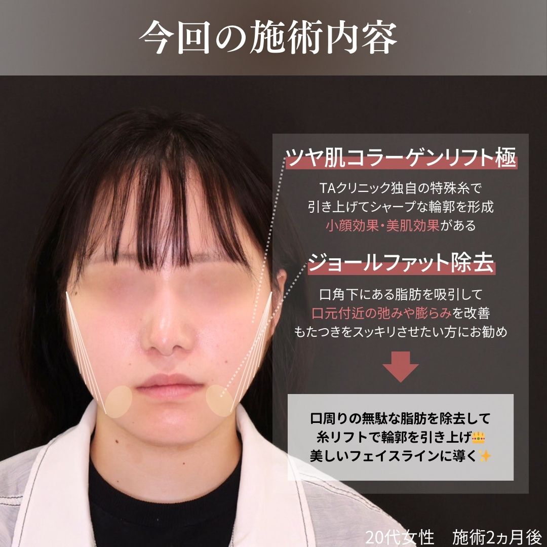 TAC式 ツヤ肌コラーゲンリフト®/ジョールファット除去の症例写真 施術前後 