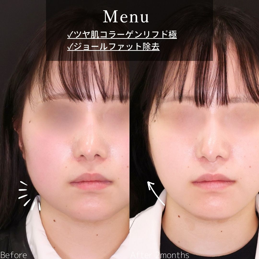 TAC式 ツヤ肌コラーゲンリフト®/ジョールファット除去の症例写真 施術前後 