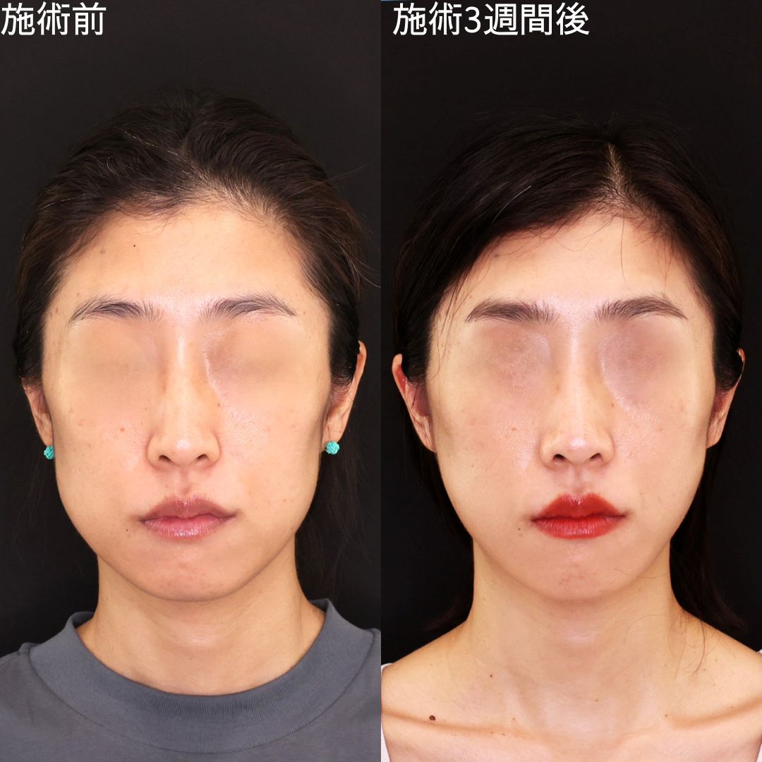 糸リフトで輪郭を整え洗練させるDr.石橋の糸リフト【糸リフト】