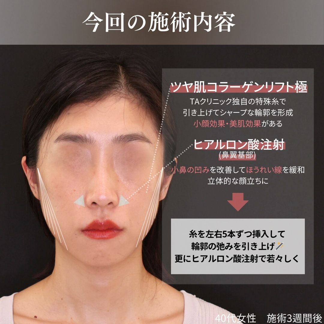 TAC式 ツヤ肌コラーゲンリフト®の症例写真 施術前後 