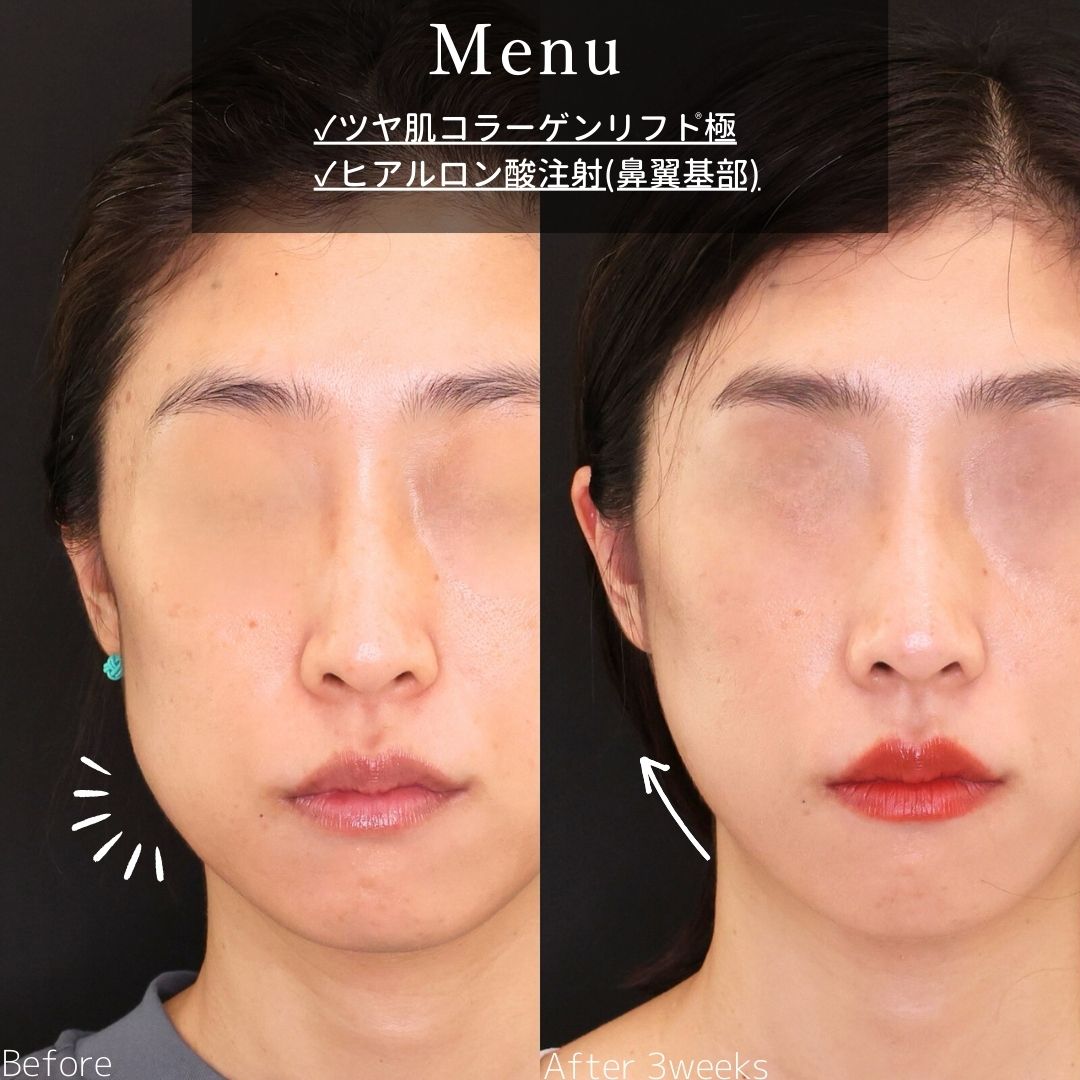 TAC式 ツヤ肌コラーゲンリフト®の症例写真 施術前後 