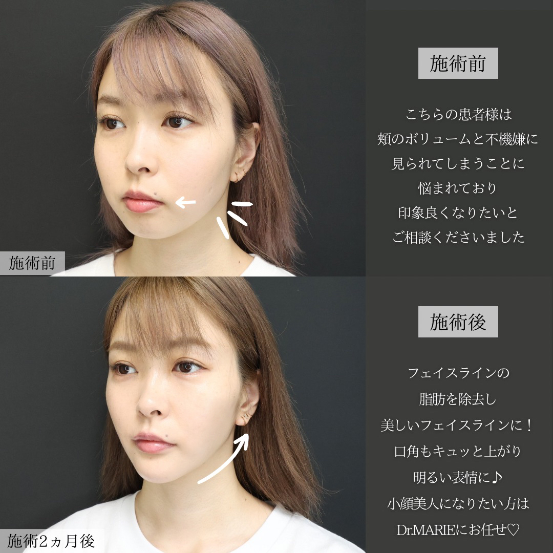 バッカルファット除去/ジョールファット除去/TAC式 ツヤ肌コラーゲンリフト®の症例写真 施術前後 