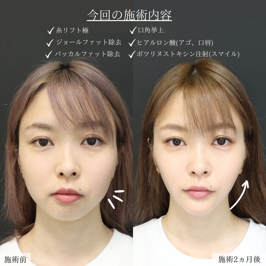 バッカルファット除去/ジョールファット除去/TAC式 ツヤ肌コラーゲンリフト®の症例写真 施術前後 