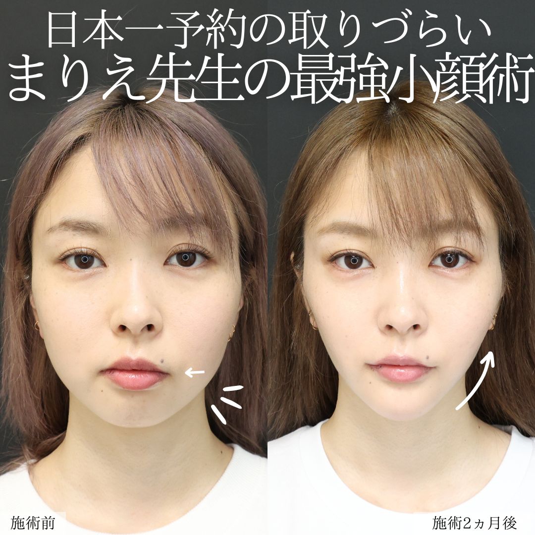 バッカルファット除去/ジョールファット除去/TAC式 ツヤ肌コラーゲンリフト®の症例写真 施術前後 