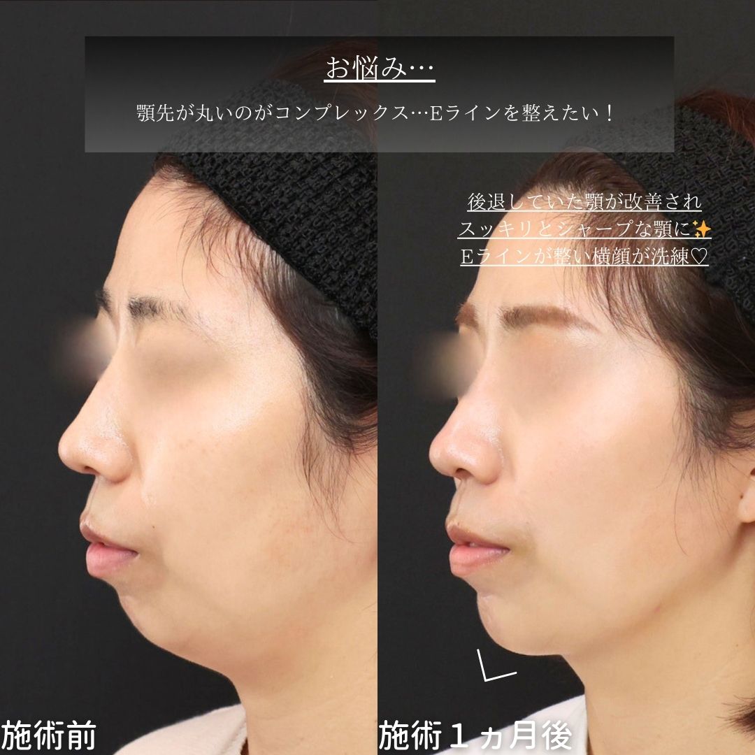 顎のヒアルロン酸注射/Lラインファット除去（エラ下脂肪除去）/TAC式 ツヤ肌コラーゲンリフト®の症例写真 施術前後 