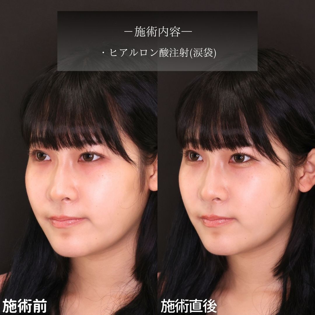 涙袋形成（ヒアルロン酸注射）の症例写真 施術前後 