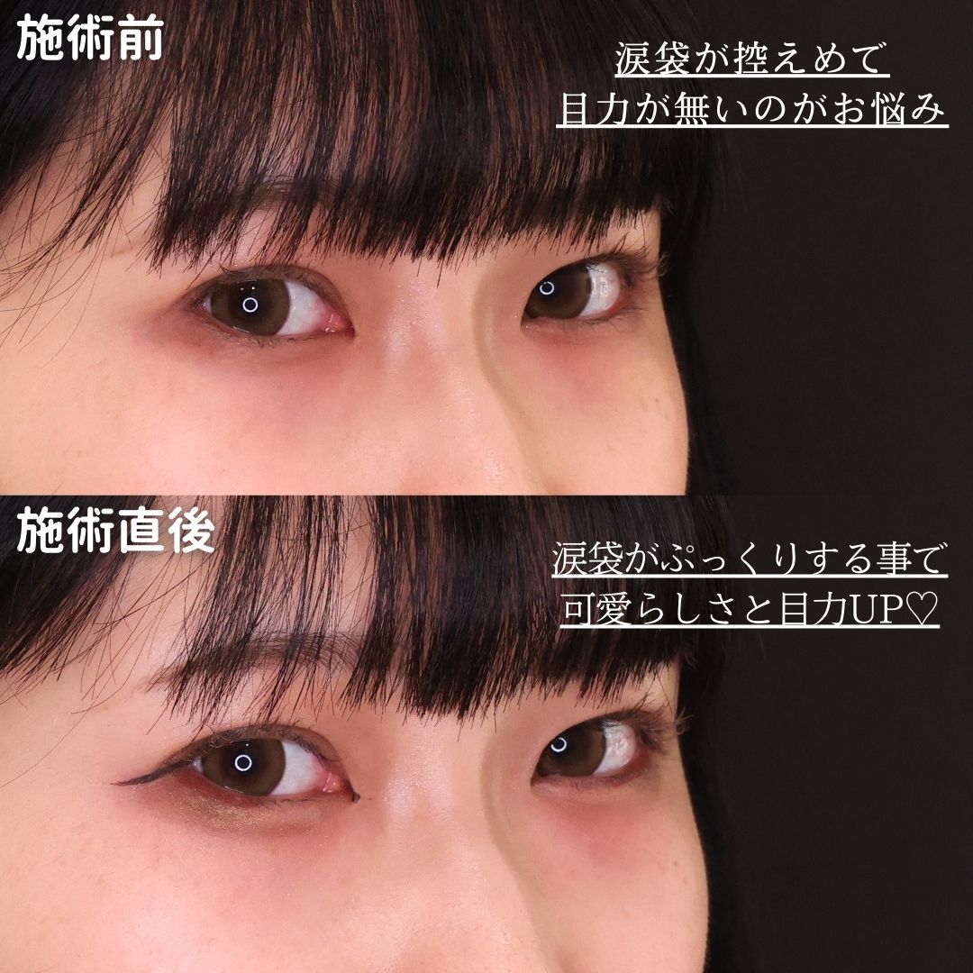 涙袋形成（ヒアルロン酸注射）の症例写真 施術前後 