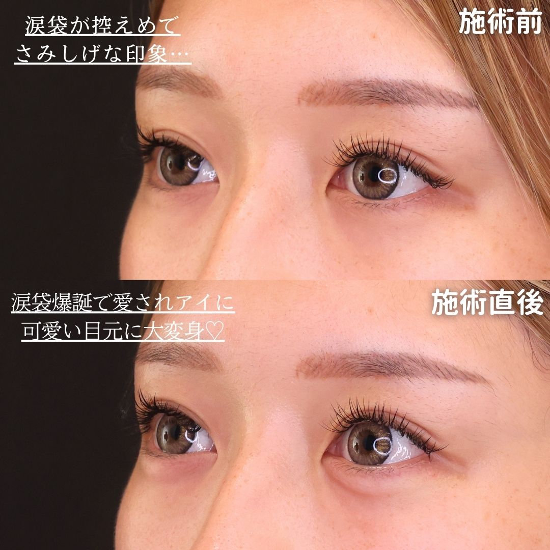 涙袋形成（ヒアルロン酸注射）の症例写真 施術前後 