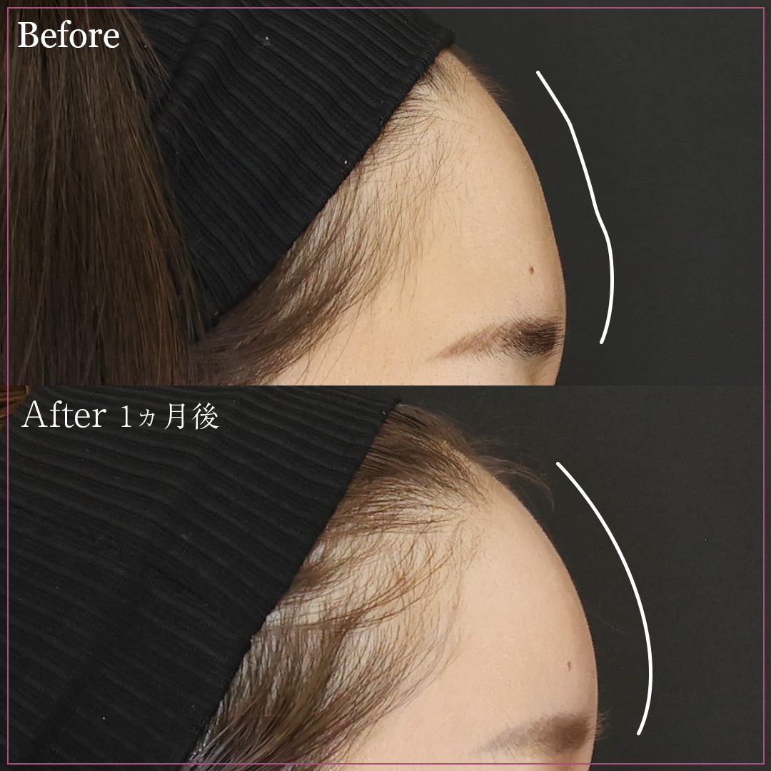 【コンデンスリッチフェイス】女性らしい丸みのあるおでこに