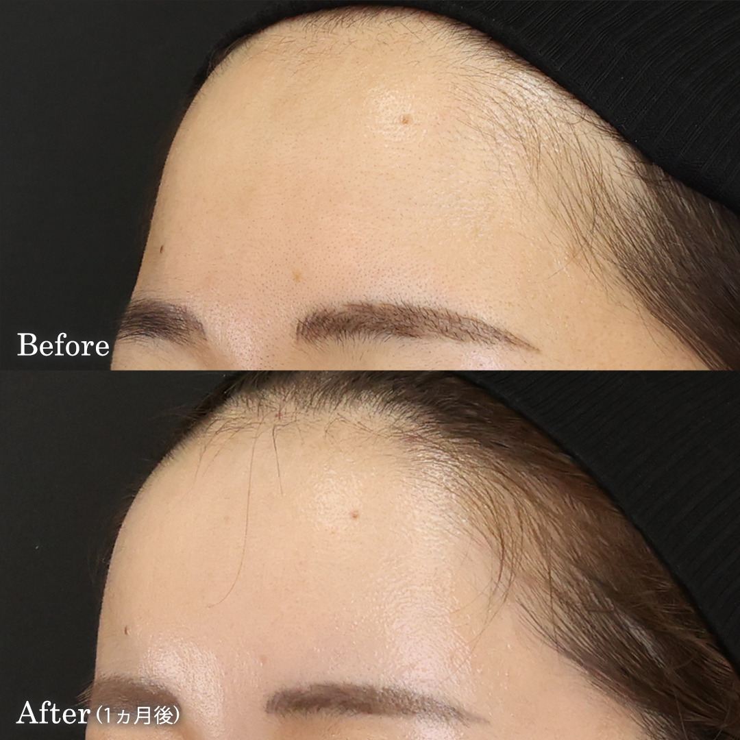 顔の脂肪注入(コンデンスリッチフェイス)の症例写真 施術前後 