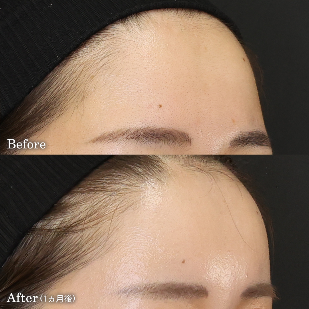 顔の脂肪注入(コンデンスリッチフェイス)の症例写真 施術前後 