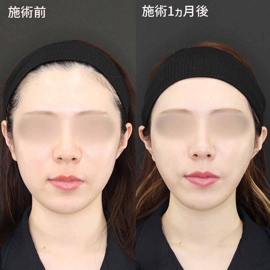 どんな時も美しく！理想を叶える小顔術