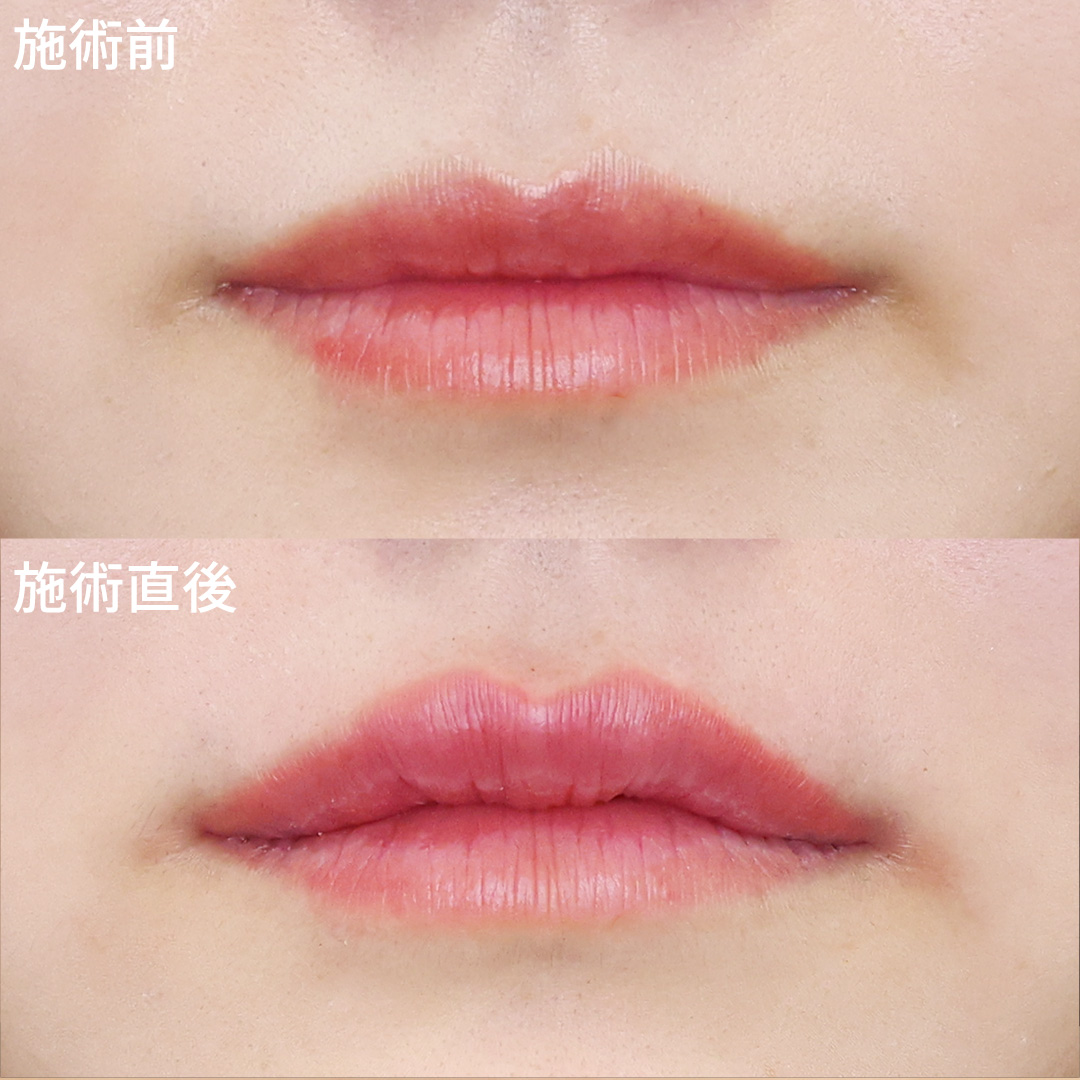 唇ヒアルロン酸+口角ボトックス+人中短縮ボトックスで立体感のある唇に！