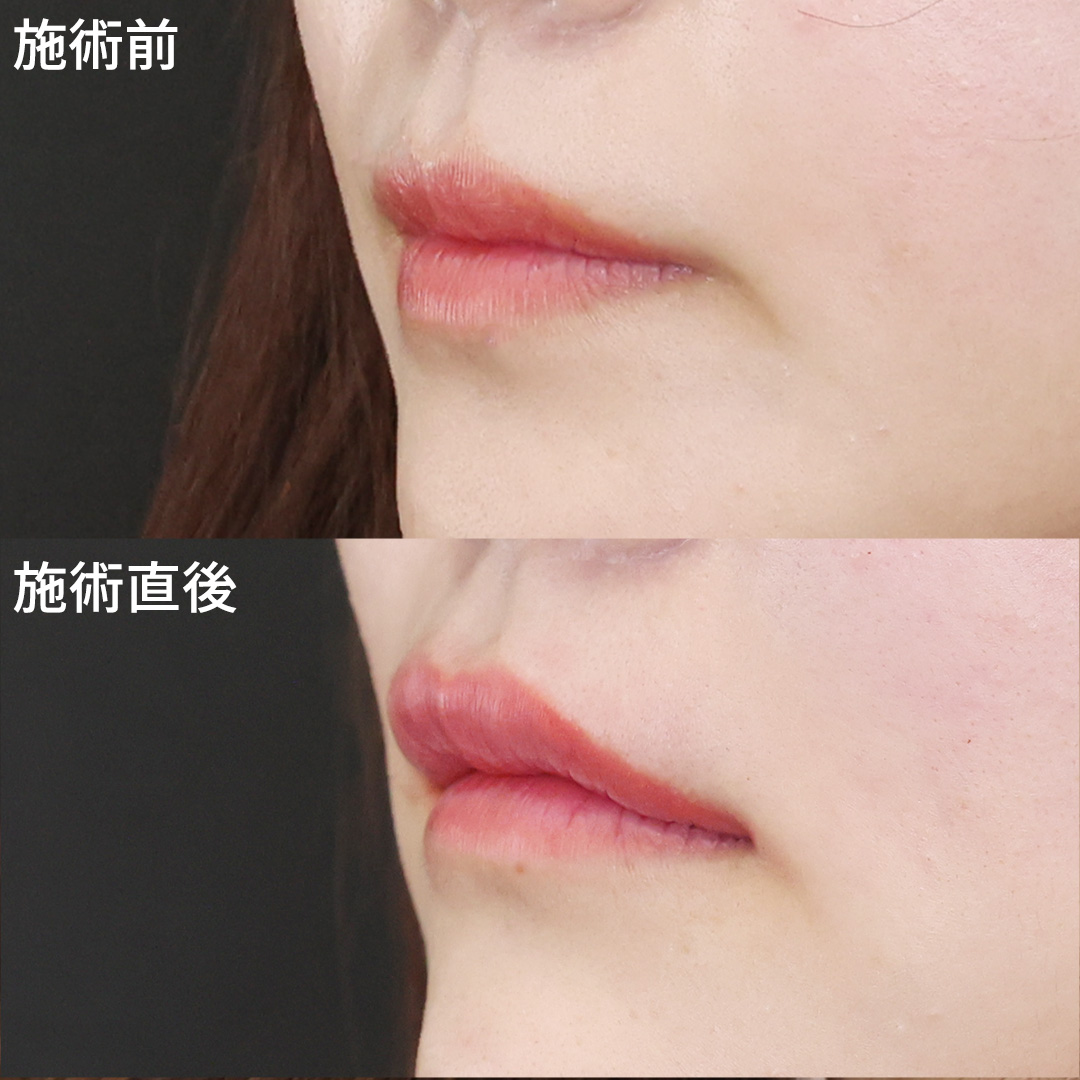 ヒアルロン酸注射：その他/ボトックス注射：その他の症例写真 施術前後 