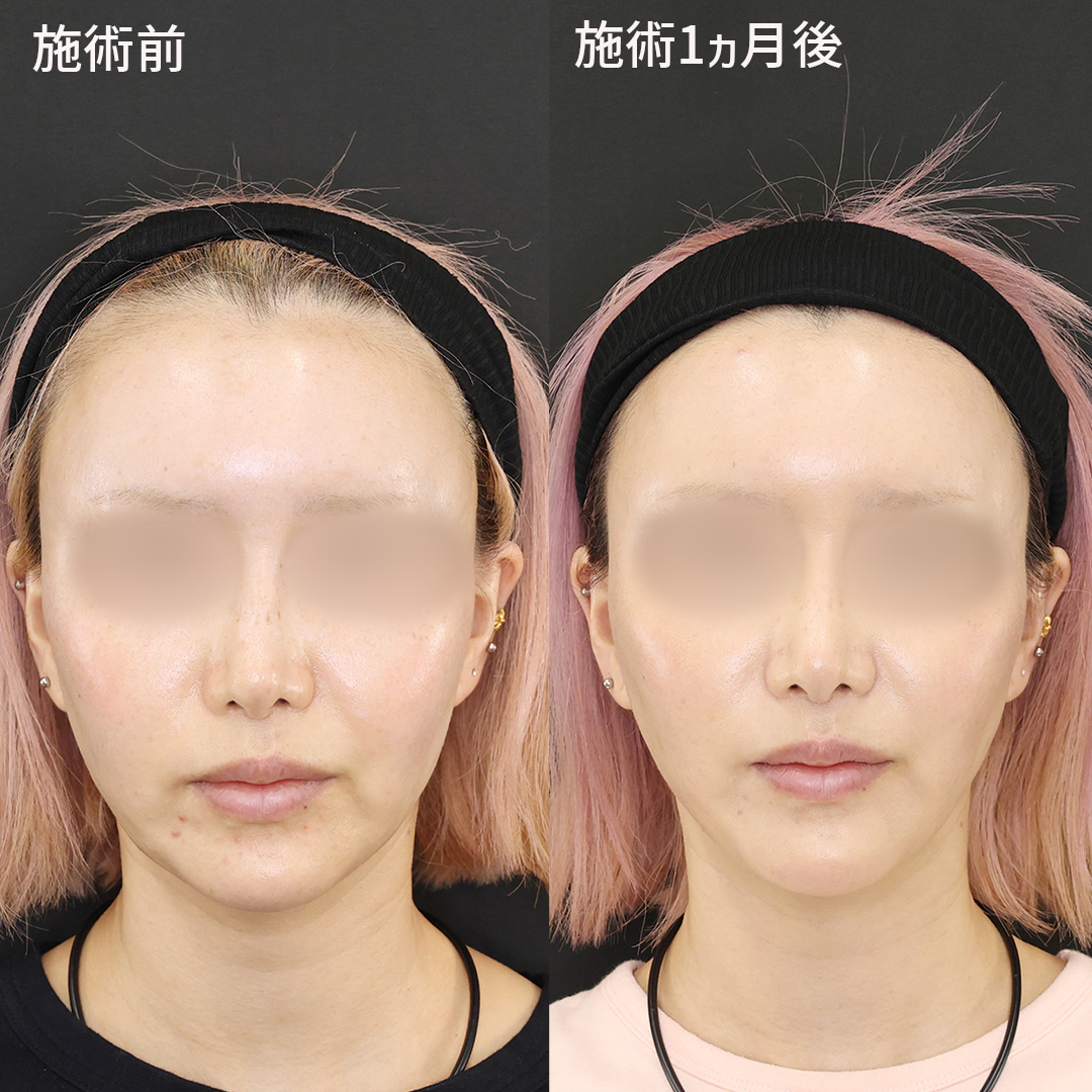 TAC式 ツヤ肌コラーゲンリフト®の症例写真 施術前後