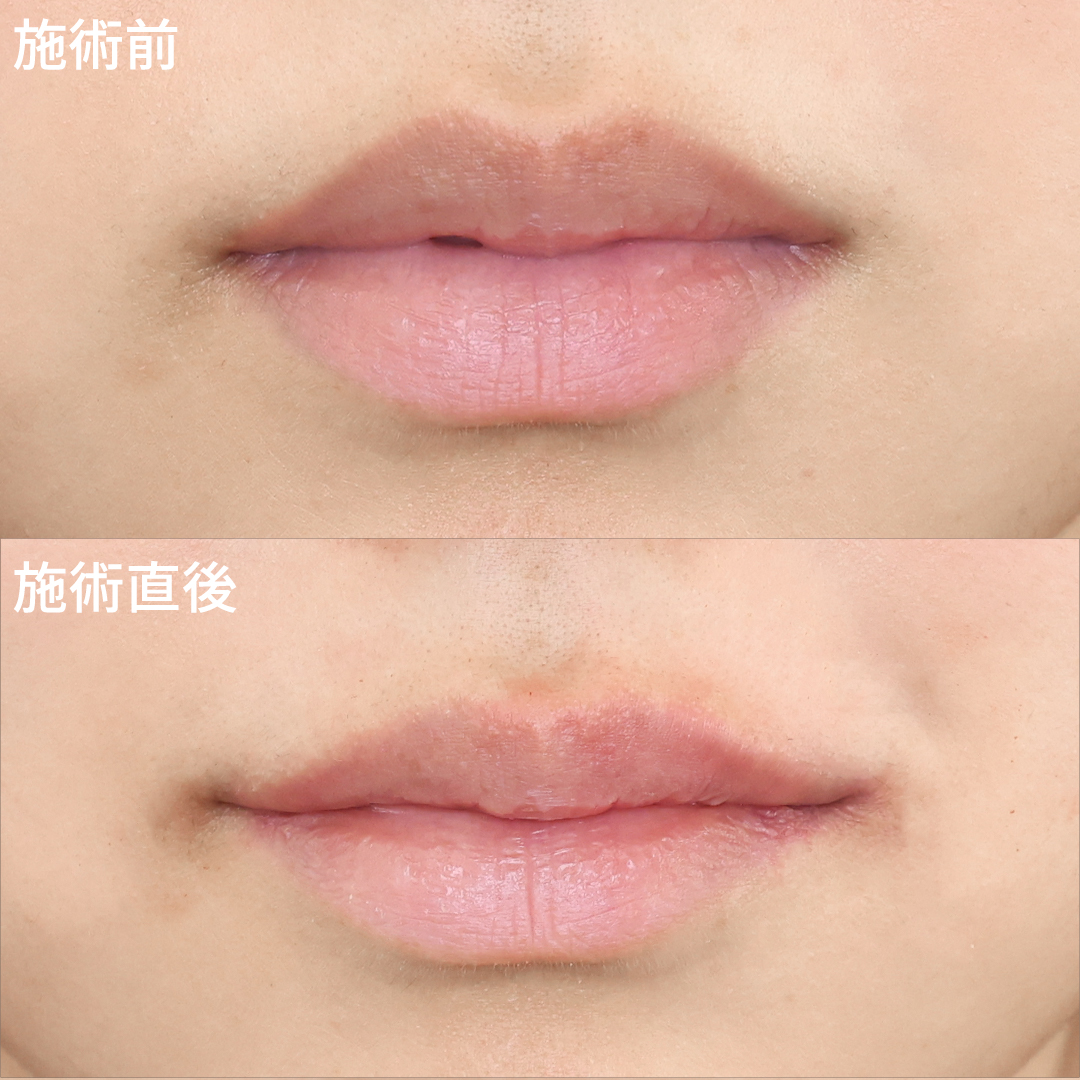 スマイルリップで自然に笑顔になれる！ヒアル＆ボトックス注射のプチ整形！
