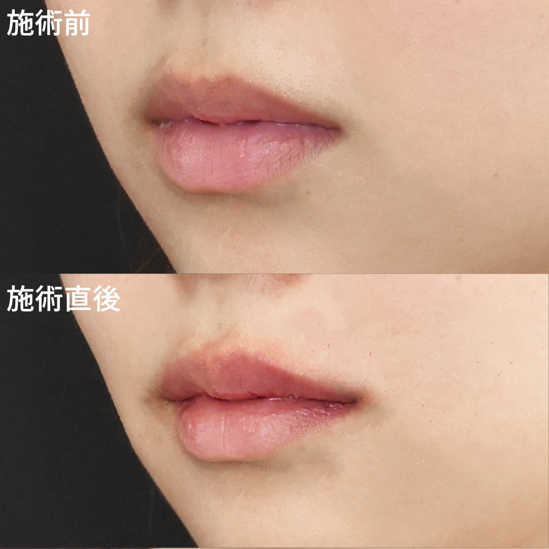 ヒアルロン酸注射：その他/ボトックス注射：その他の症例写真 施術前後 