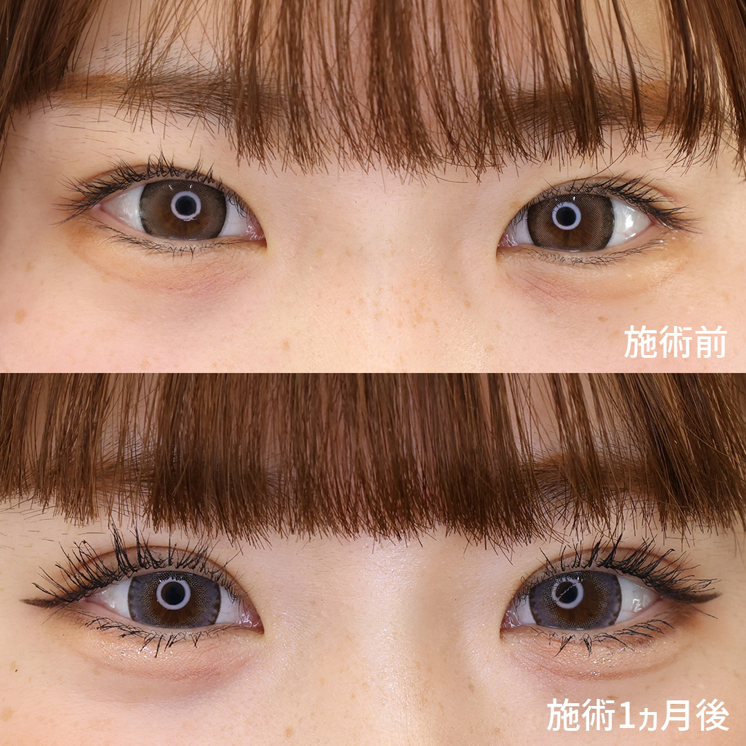 二重埋没法の症例写真 施術前後 