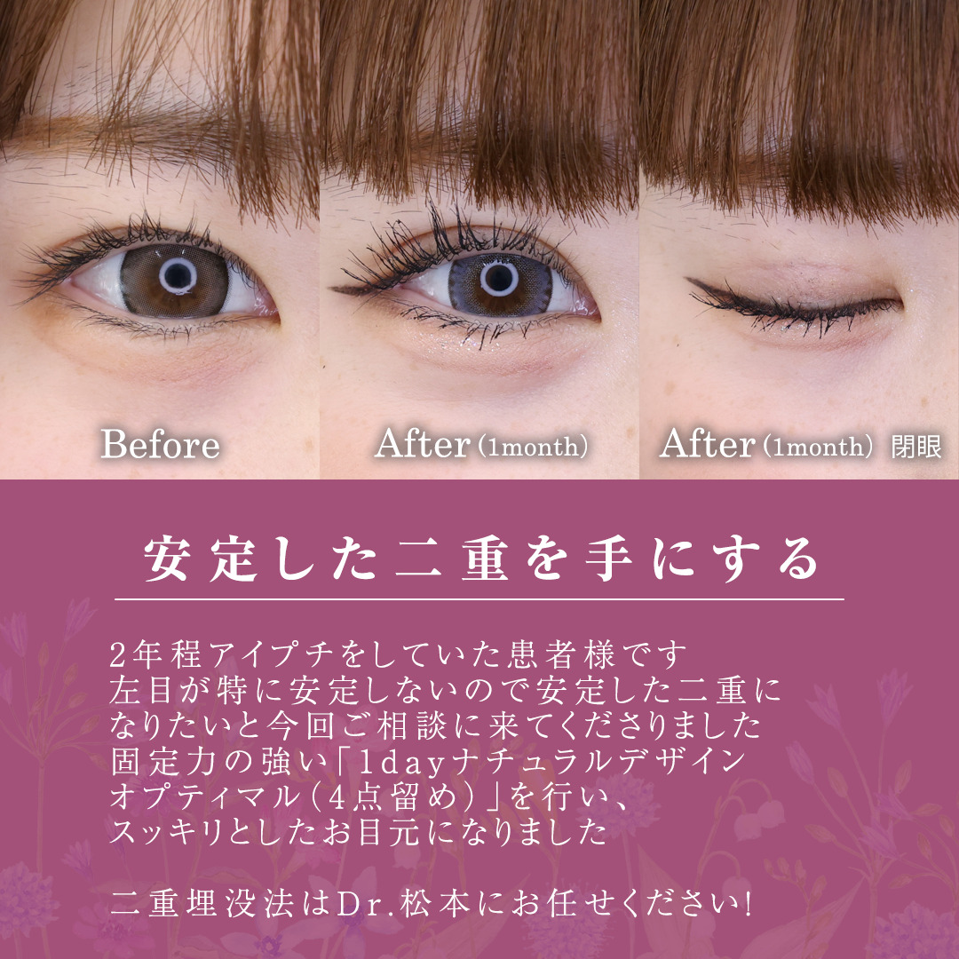 二重埋没法の症例写真 施術前後 