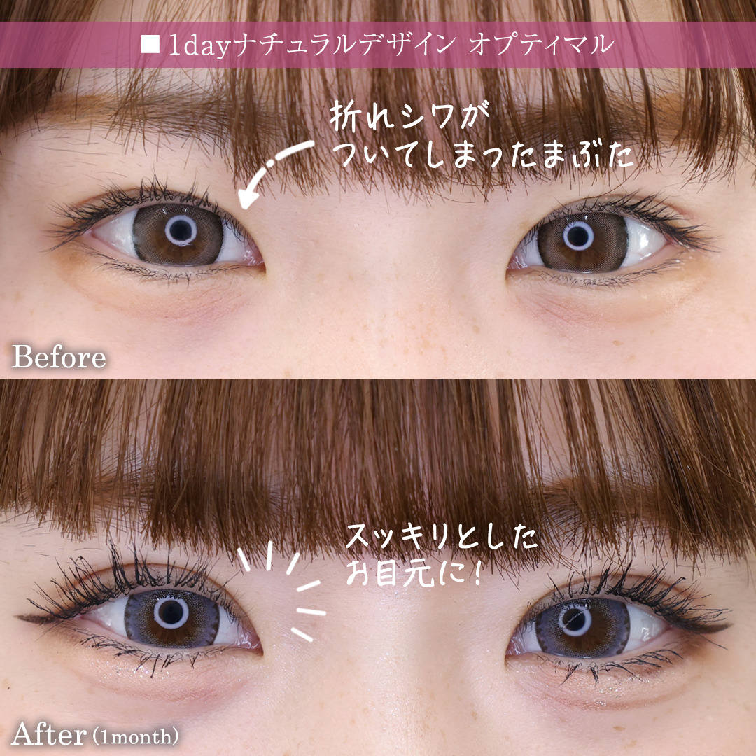 二重埋没法の症例写真 施術前後 