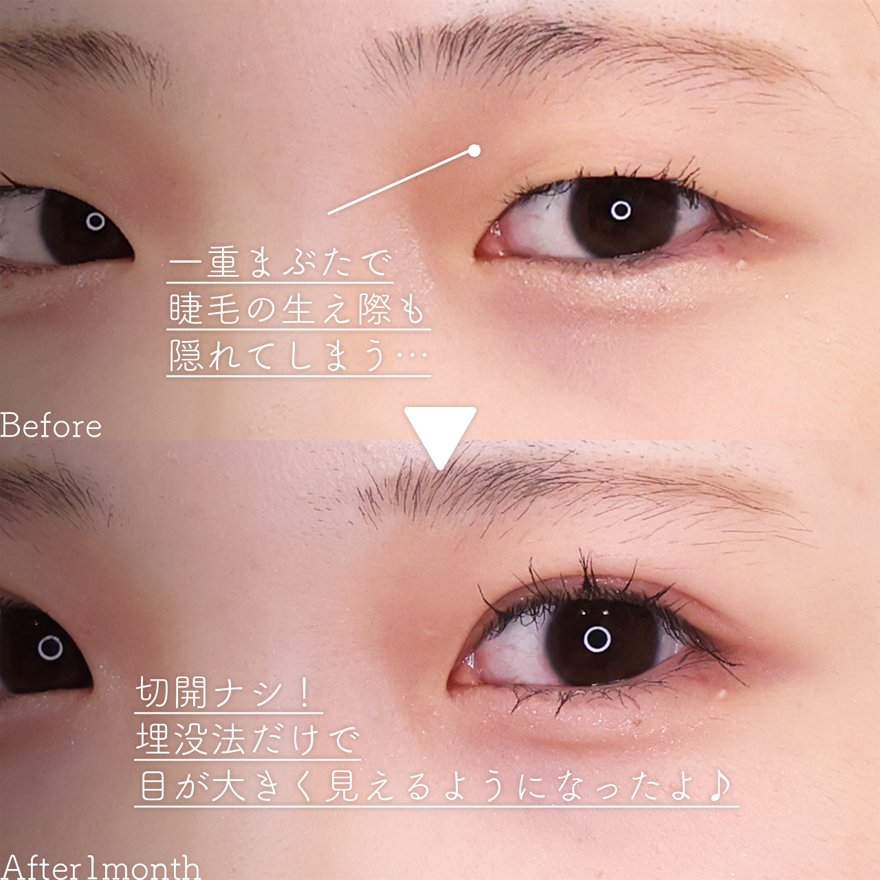 二重埋没法の症例写真 施術前後 