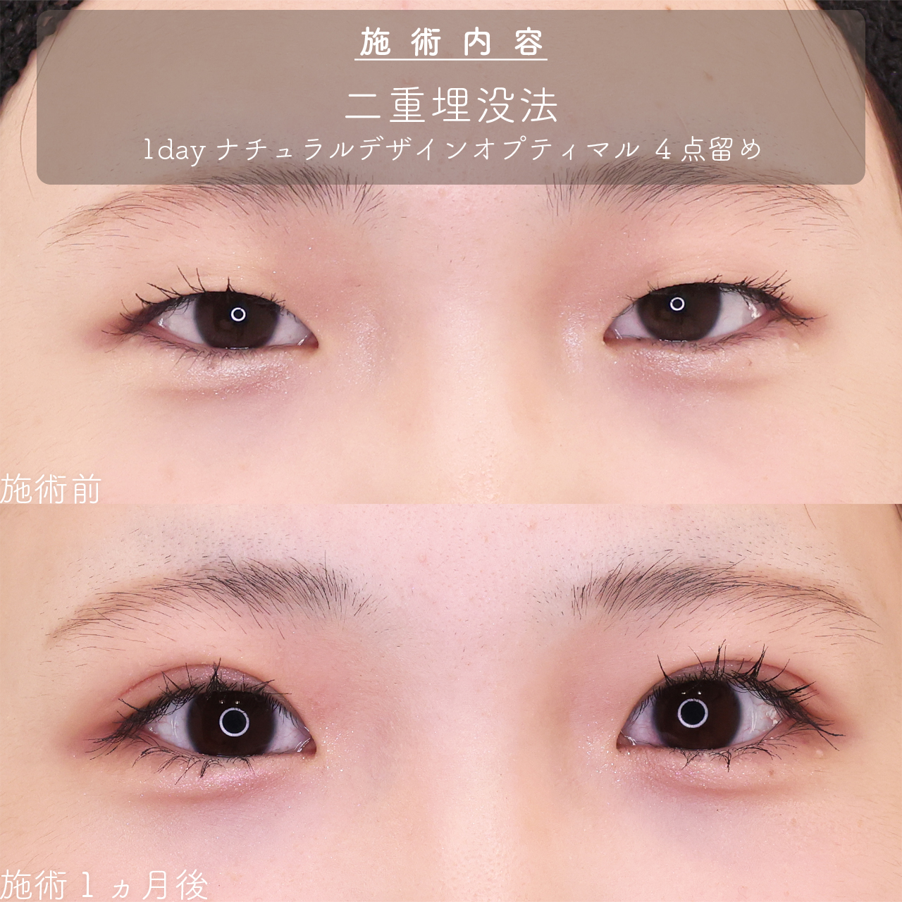 二重埋没法の症例写真 施術前後 