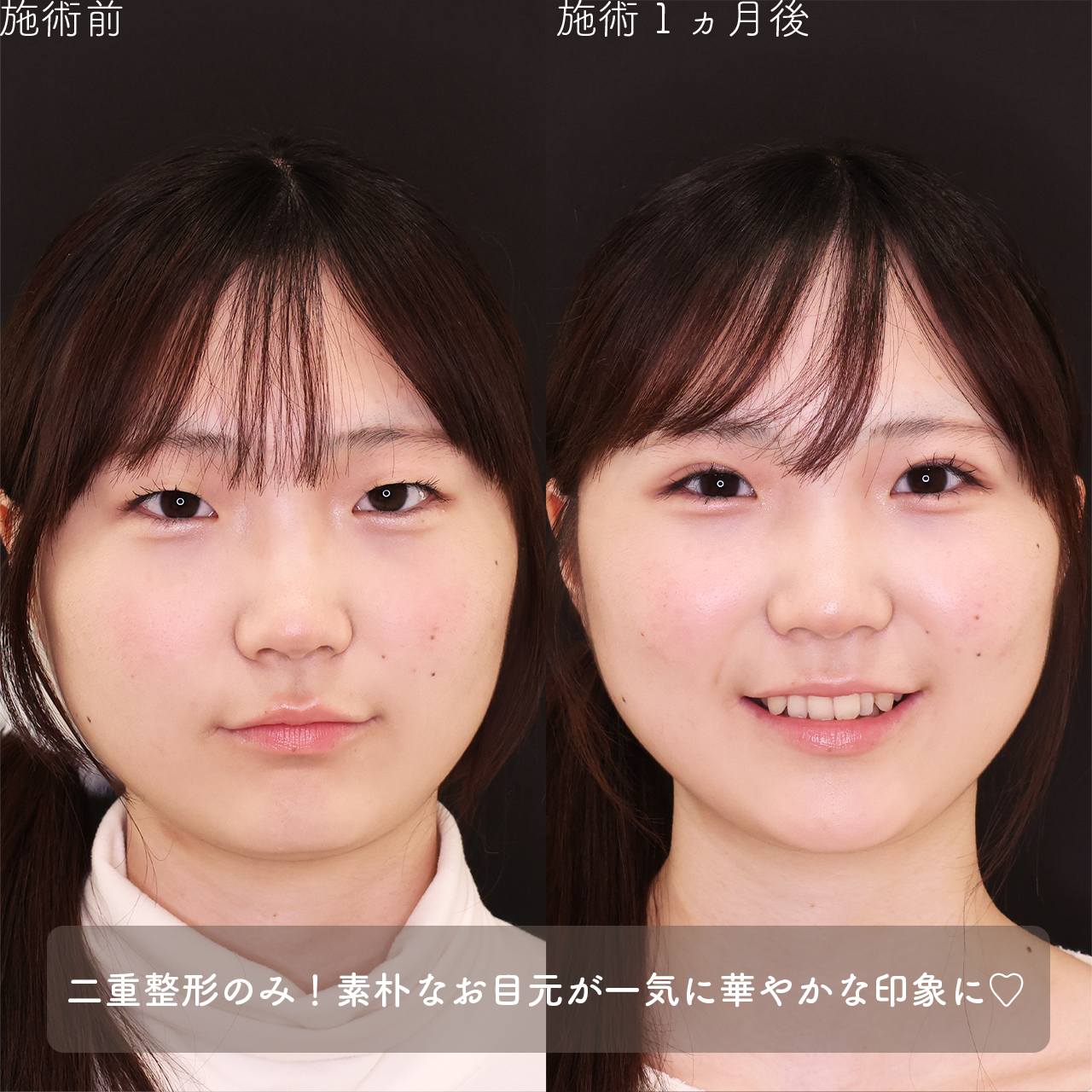 二重埋没法の症例写真 施術前後 