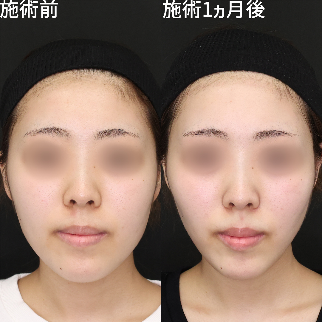 最小限のダウンタイムで輪郭スッキリ小顔に！