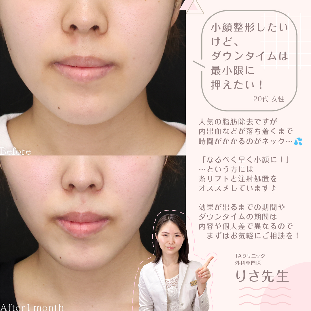 TAC式 ツヤ肌コラーゲンリフト®/エラボトックス注射の症例写真 施術前後 