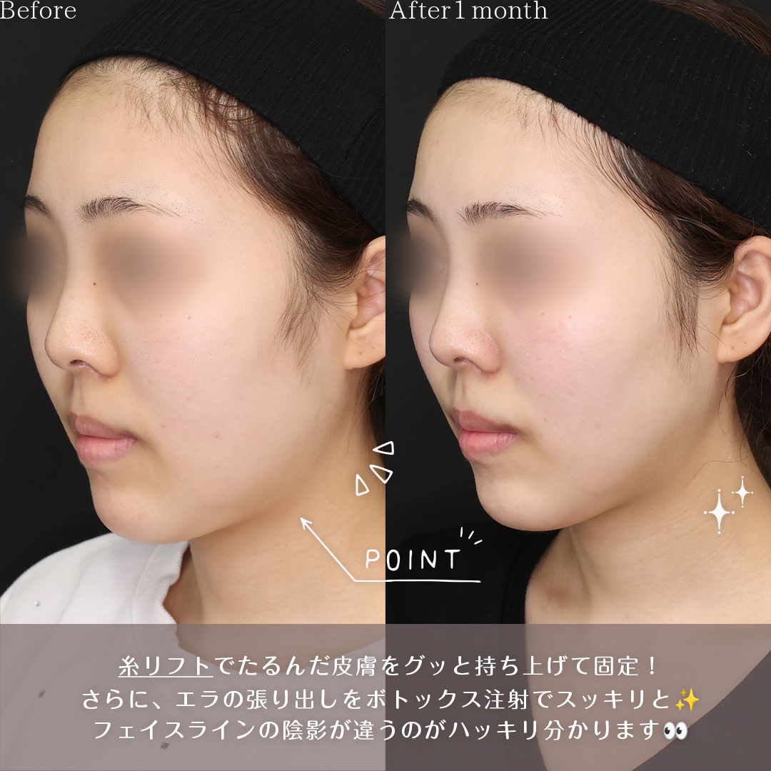 TAC式 ツヤ肌コラーゲンリフト®/エラボトックス注射の症例写真 施術前後 