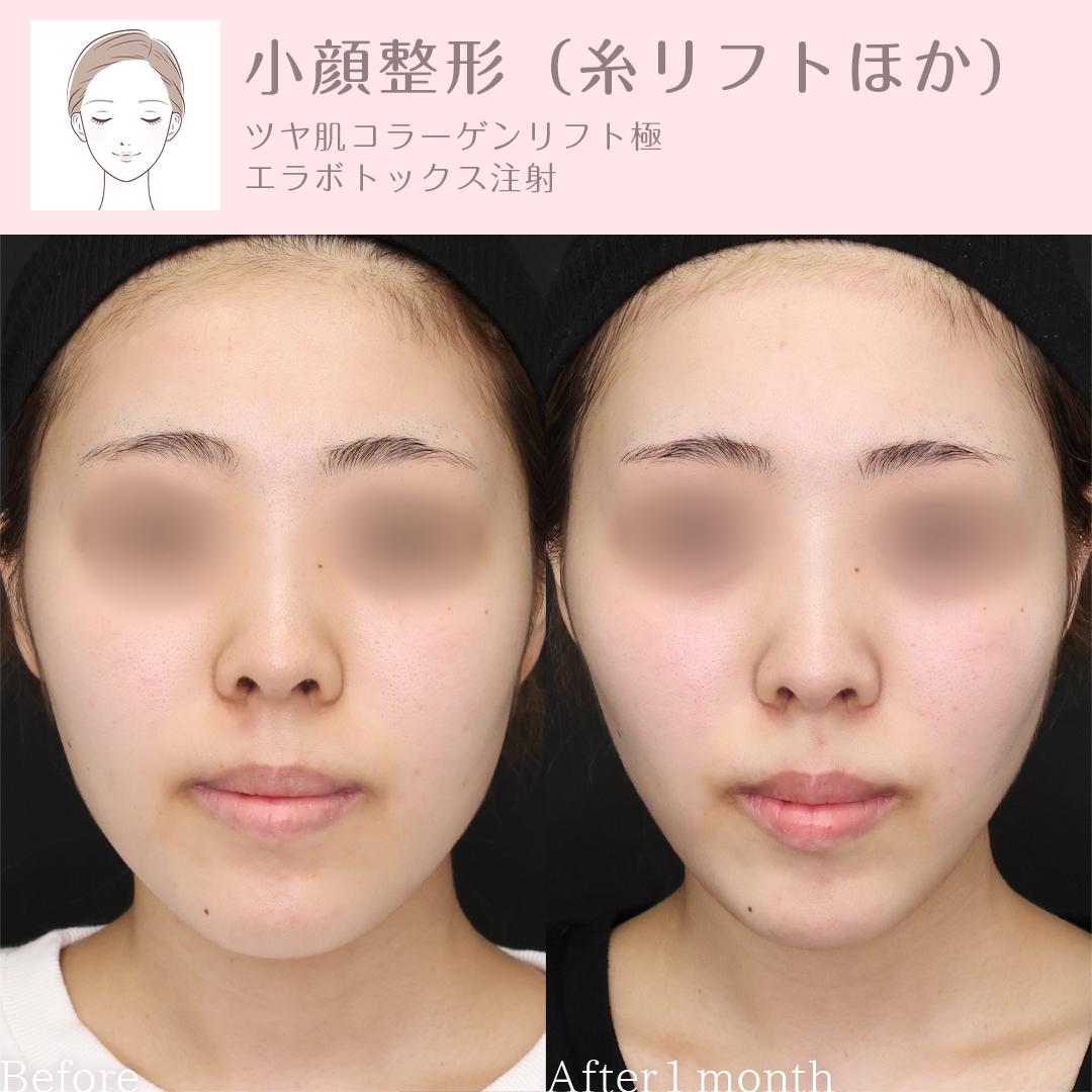 TAC式 ツヤ肌コラーゲンリフト®/エラボトックス注射の症例写真 施術前後 