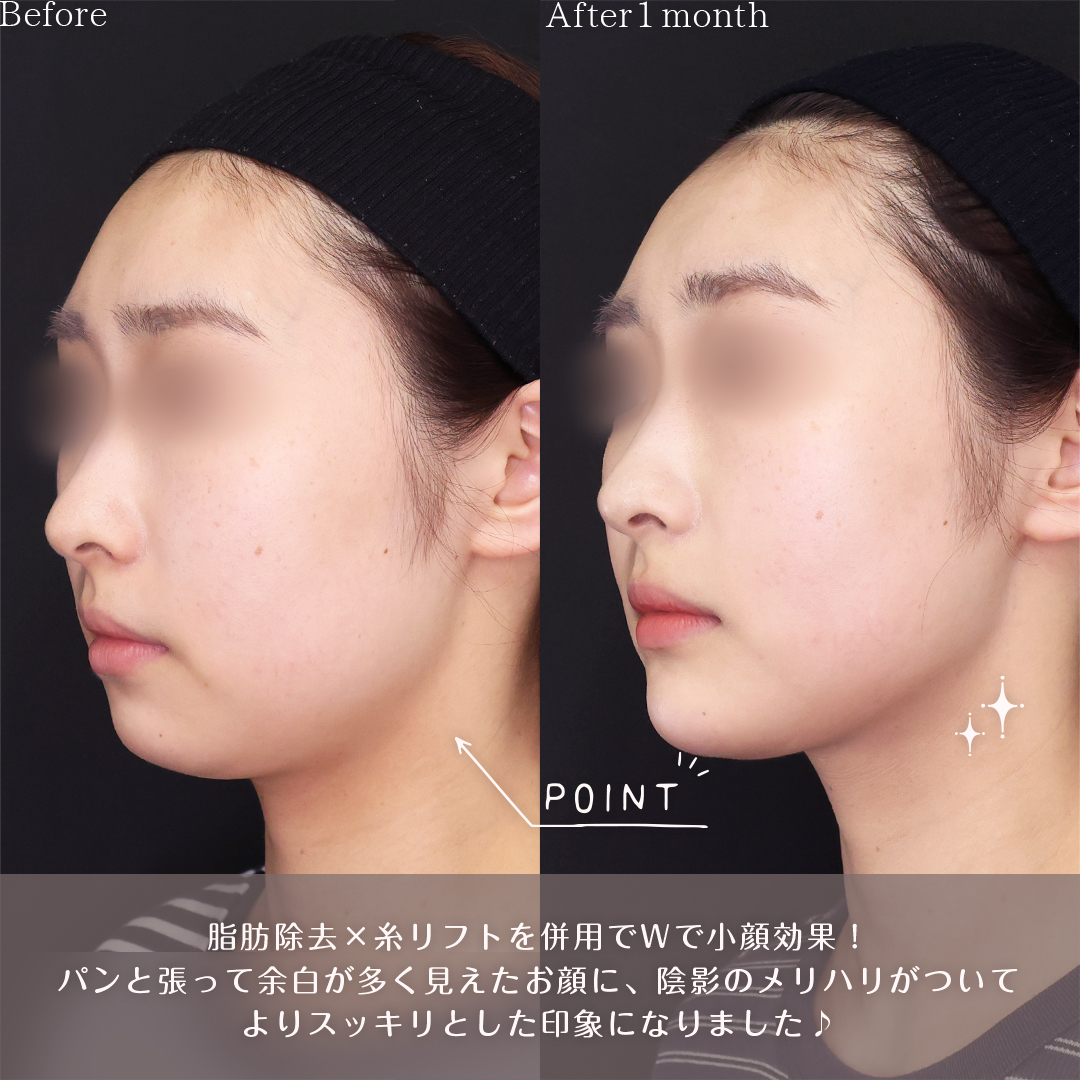 小顔整形|パーフェクトフェイスライン/TAC式 ツヤ肌コラーゲンリフト®/Lラインファット除去(エラ下脂肪除去)の症例写真 施術前後
