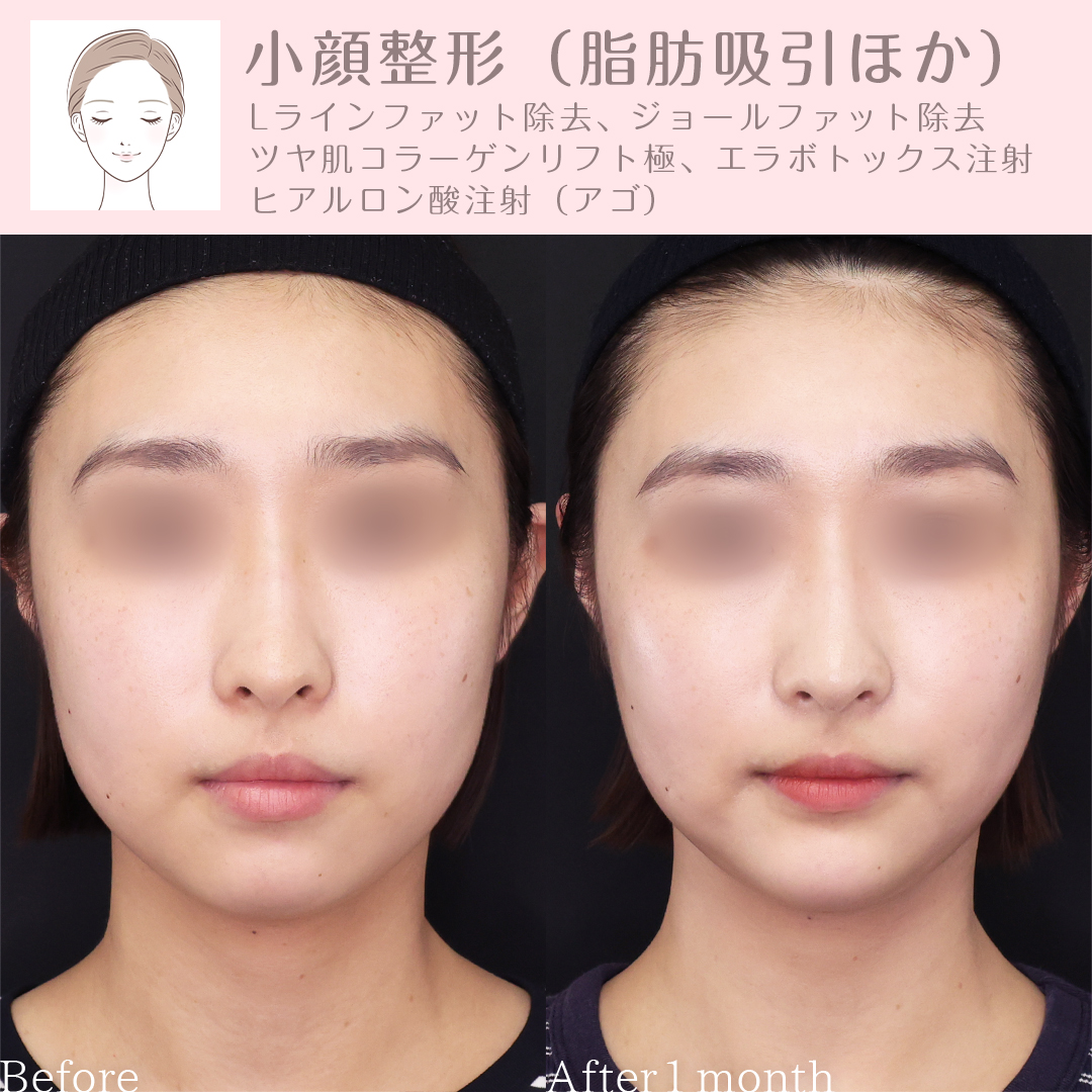 小顔整形|パーフェクトフェイスライン/TAC式 ツヤ肌コラーゲンリフト®/Lラインファット除去(エラ下脂肪除去)の症例写真 施術前後
