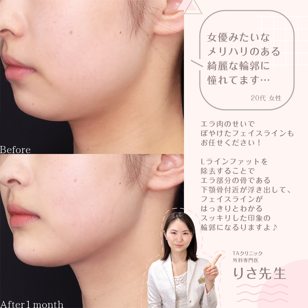 小顔整形|パーフェクトフェイスライン/TAC式 ツヤ肌コラーゲンリフト®/Lラインファット除去(エラ下脂肪除去)の症例写真 施術前後
