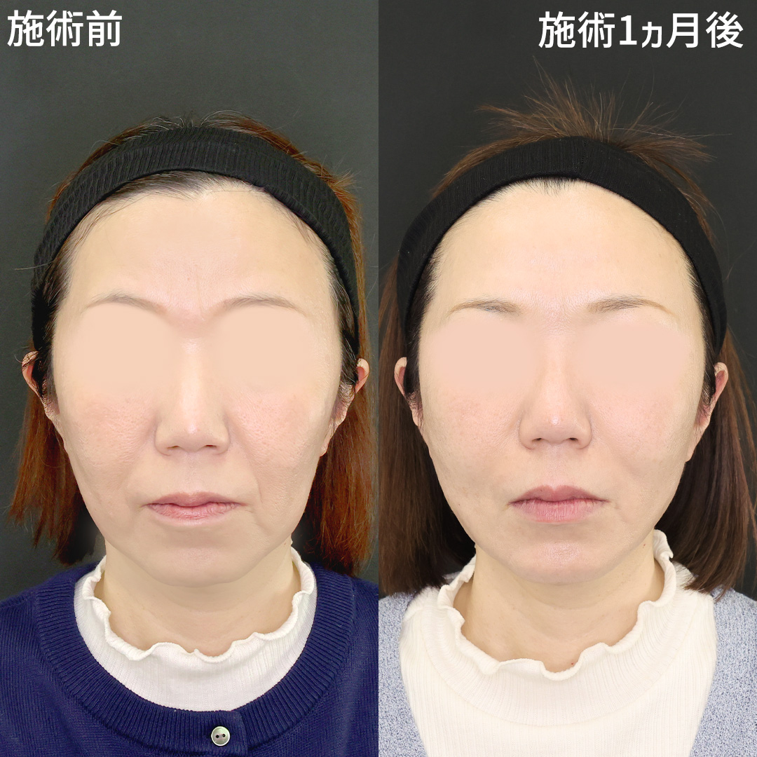 切らない小顔整形で若返り！