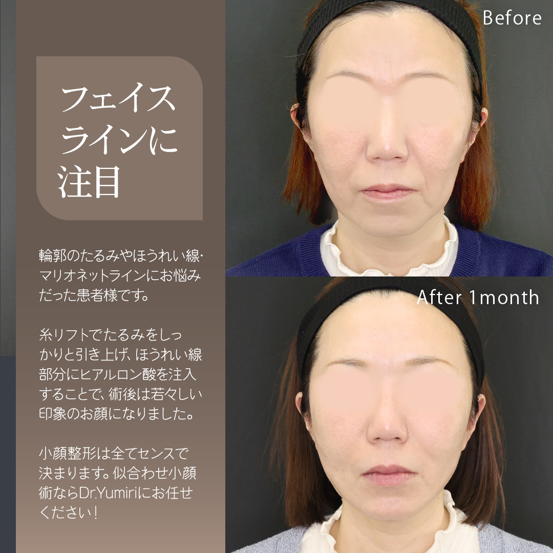 TAC式 ツヤ肌コラーゲンリフト®/TAC式 ショッピングリフト/ほうれい線のヒアルロン酸注射の症例写真 施術前後